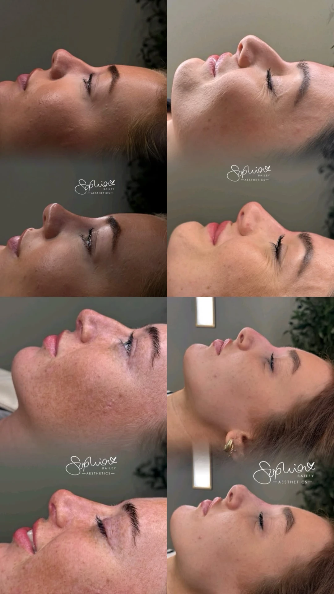 Liquid rhinoplasty results collage by Sophia Bailey Aesthetics